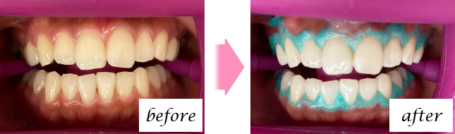 Before After