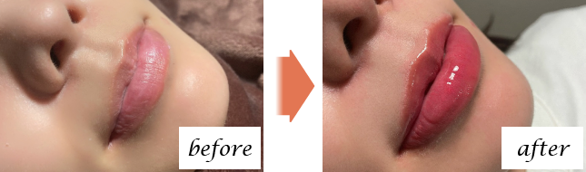 Before After